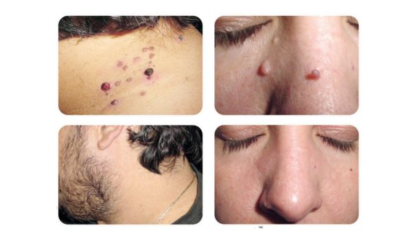 antes despues crioterapia cryopen medical