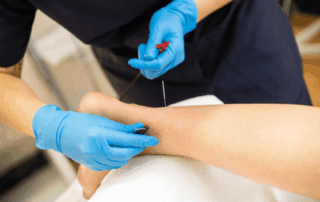 agujas de puncion seca fisioterapia