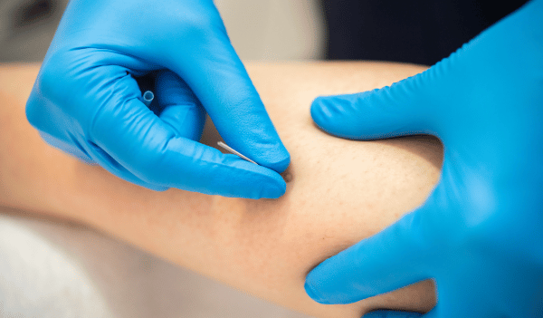 agujas de puncion seca fisioterapia prueba agujas de puncion seca fisioterapia prueba